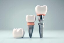 Dental implants